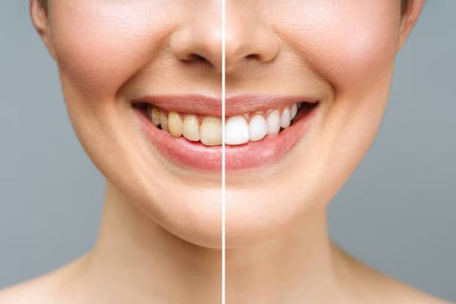 woman teeth before and after whitening