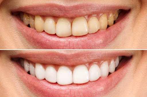 woman teeth before and after whitening