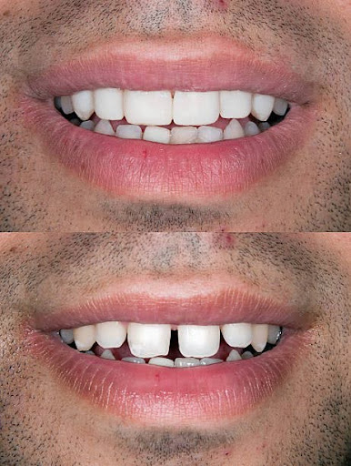 Before and after Smile design dental procedure photos . Selective soft focus.