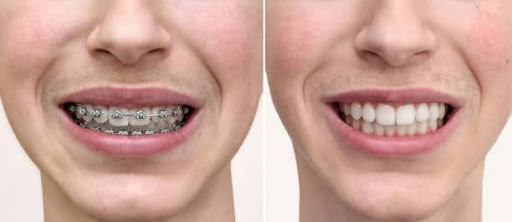 Two portraits of the same teenage boy with and without braces on his teeth. Before and after. Close-up. Health care and medical concept.