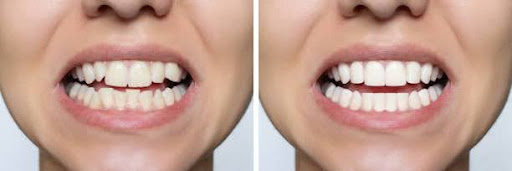 Young woman's smile before and after teeth straightening. Ideal, beautiful shape of teeth on the upper and lower jaw after installing veneers or braces. Bleaching. Dental clinic patient.