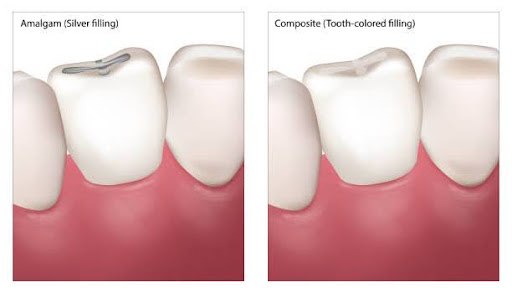 Dental Filling Procedure