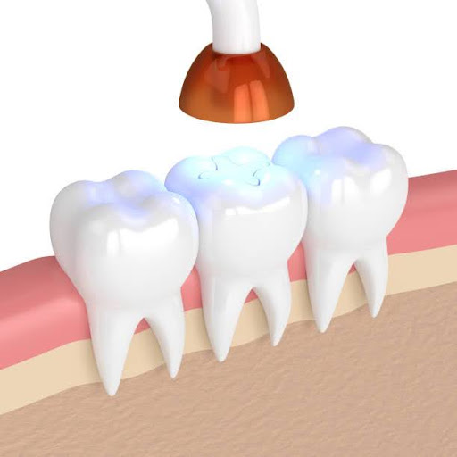 3d render of teeth with dental polymerization lamp